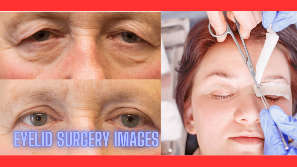 How Insurance Makes Eyelid Surgery Images Affordable and Accessible