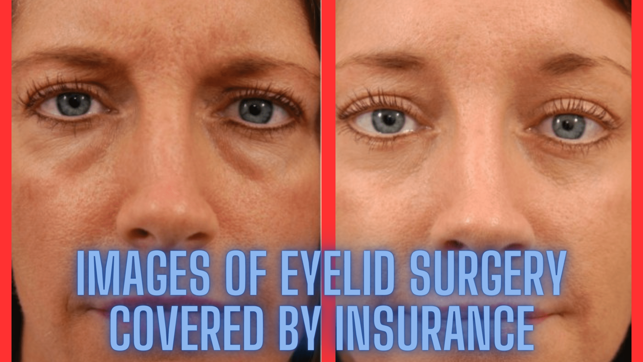 images of eyelid surgery covered by insurance